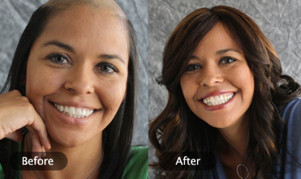 stop hair loss after bariatric surgery