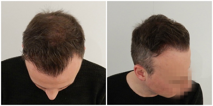 stages of hair transplant growth timeline